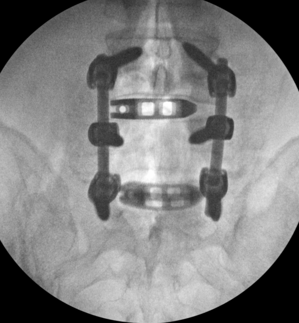 Transforaminal Lumbar Interbody Fusion Tlif Lubbock Amarillo