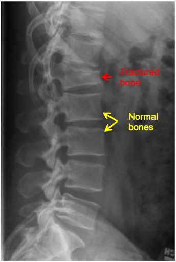 Osteoporosis and spine health - Lubbock, Amarillo, Midland | Sergiy ...