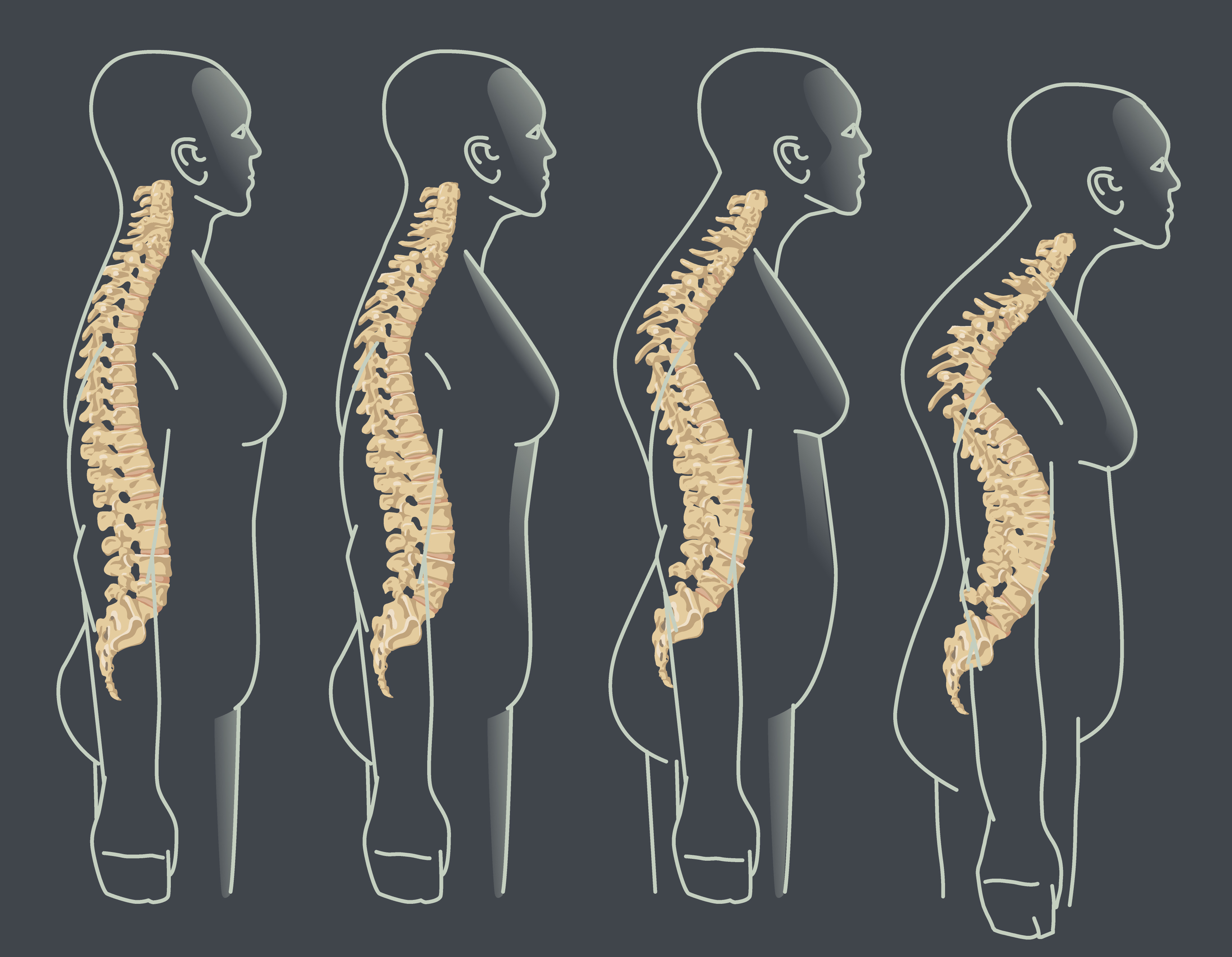 osteoporosis fracture sites