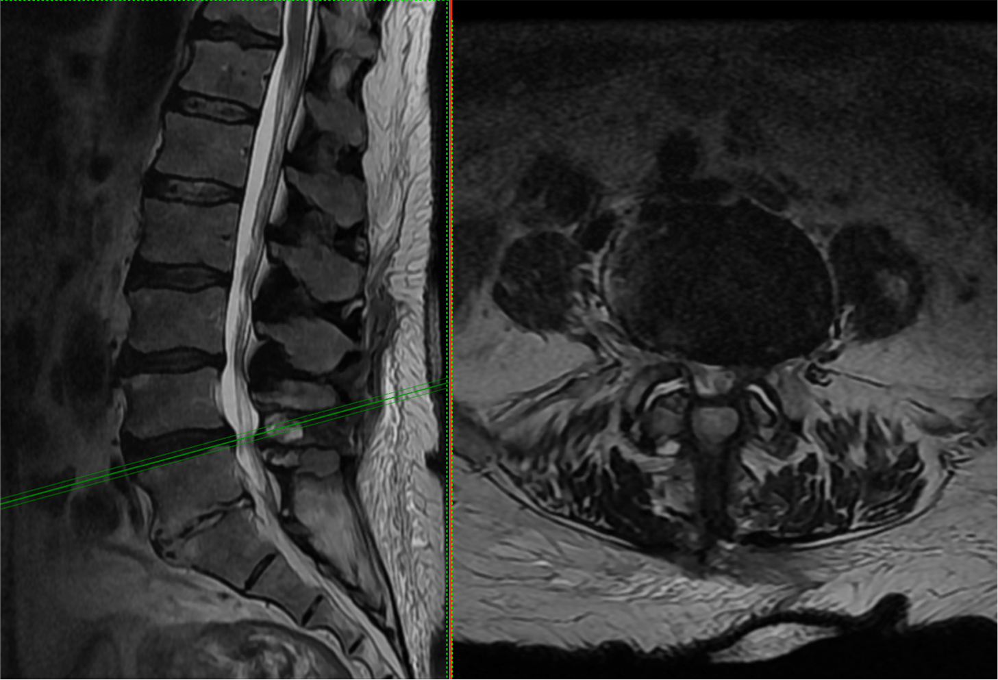 Lumbar Spinal Stenosis Patofisiologi, Diagnosis,, 50% OFF