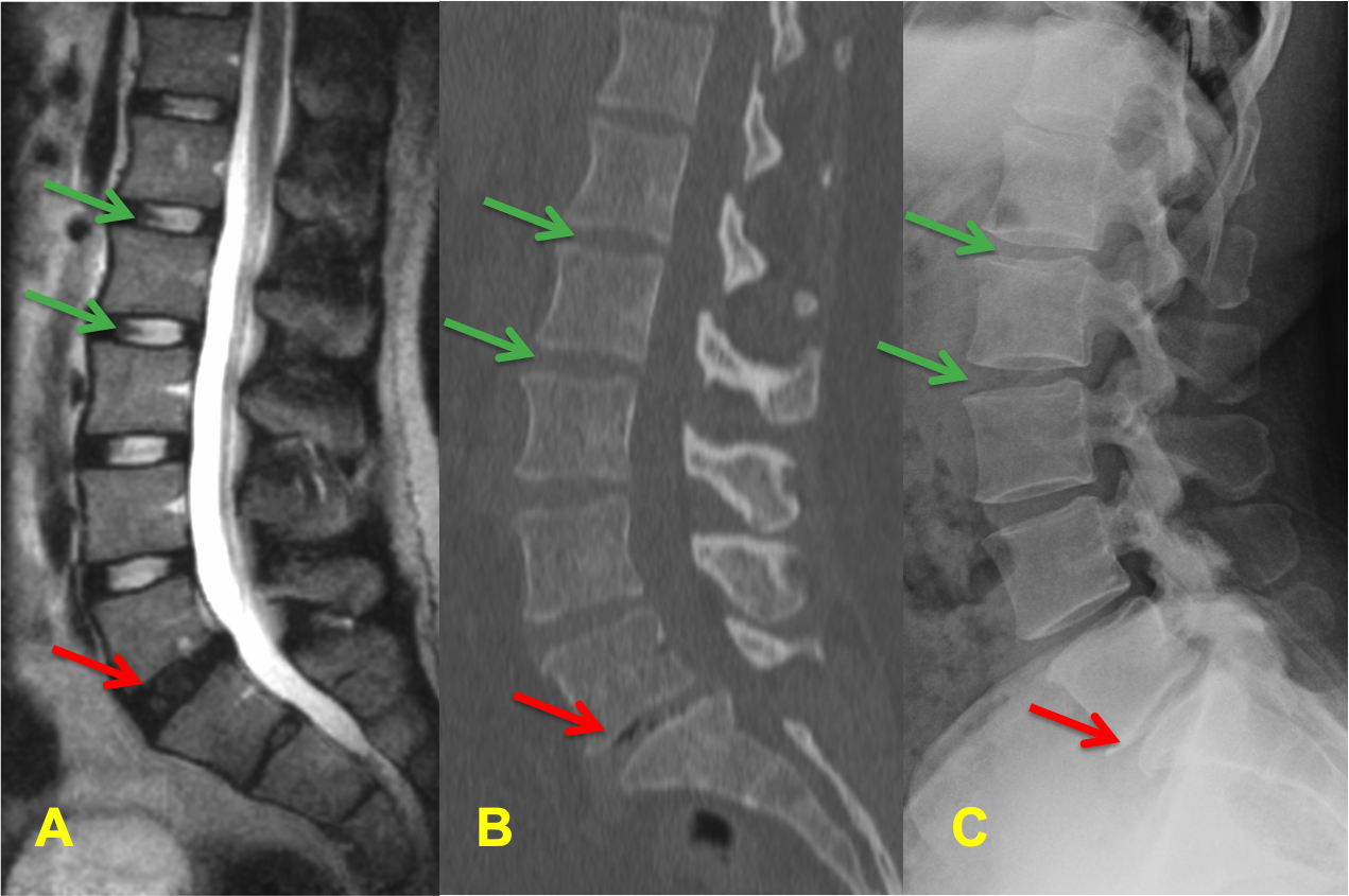 Lumbar Disc Disease Mri