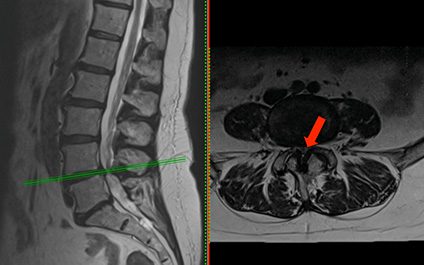 Spinal stenosis and neurogenic claudication