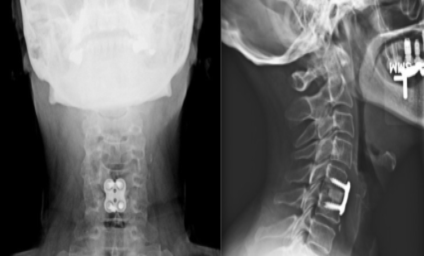 ACDF – Anterior Cervical Discectomy and Fusion