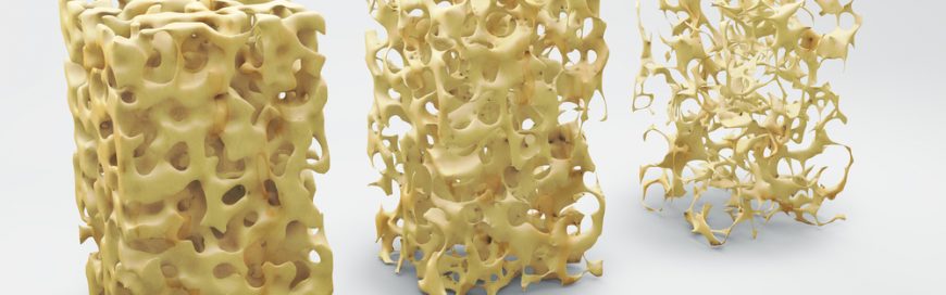 Osteoporosis and spine health