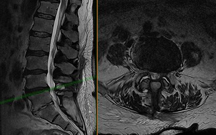 Lumbar laminectomy