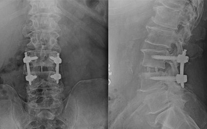 Lateral Lumbar Interbody Fusion (LLIF)