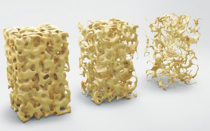 Osteoporosis and spine health