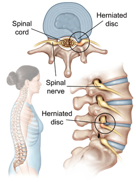 degenerative disc in thoracic spine