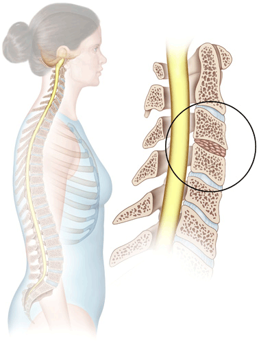 Anterior Cervical Fusion -Redlands, Loma Linda, Highland | Bones and Spine  Surgery Inc.