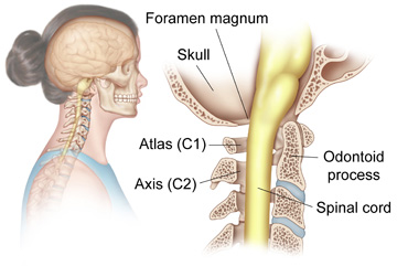 Rheumatoid Arthritis Of The Cervical Spine Redlands Loma Linda Highland Bones And Spine Surgery Inc