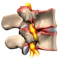 degenerative disc in thoracic spine