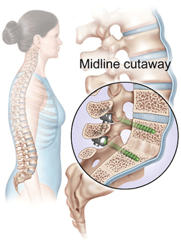 Lumbar spinal arthrodesis surgery