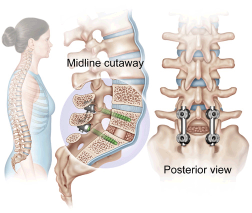 spinal-fusion-minnesota-spine-institute