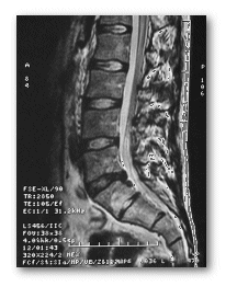 MRI Scan Redlands Loma Linda Highland Bones and Spine Surgery