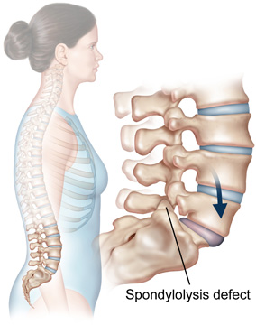 Spondylolisthesis in Athletes: Treatment and Return to Sports