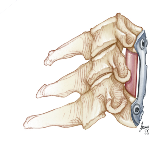 Bone Fusion Process Brochure -Redlands, Loma Linda, Highland | Bones and Spine Surgery Inc.
