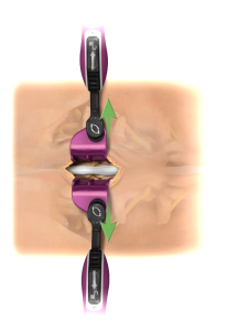 Blade attachments are used to retract the muscle on left and right side of the spine. 